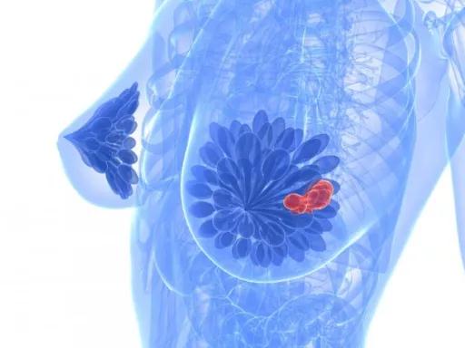 乳腺结节