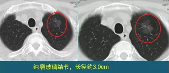 肺磨玻璃结节