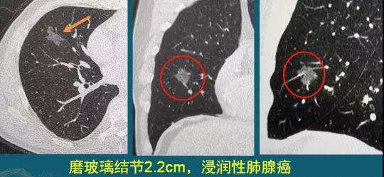 肺磨玻璃结节