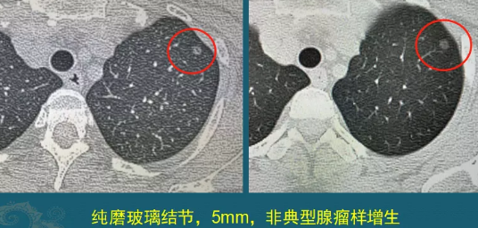 肺磨玻璃结节