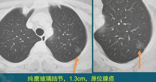 肺磨玻璃结节