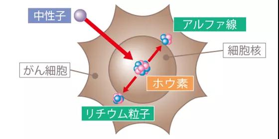 日本硼中子俘获治疗