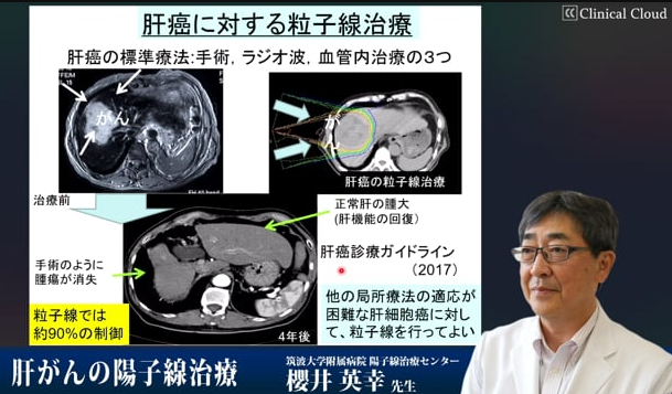 肝癌质子治疗标准制定者
