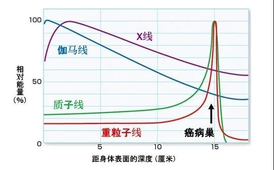 胰腺癌重离子治疗