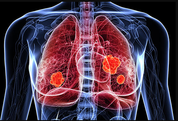 肺癌靶向治疗