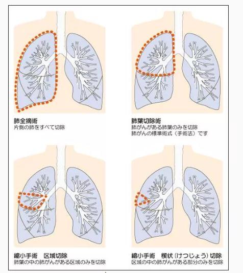 肺癌手术治疗