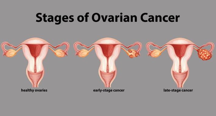卵巢癌前沿数据