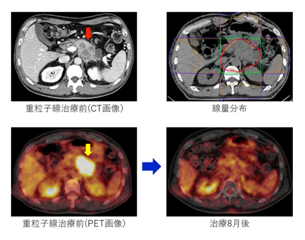 质子重离子治疗胰腺癌