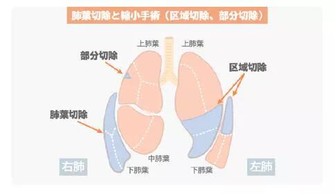 肺癌手术治疗