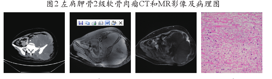 软骨肉瘤病理