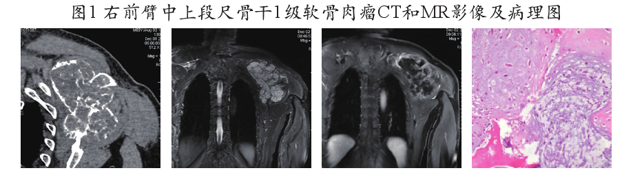 软骨肉瘤治疗