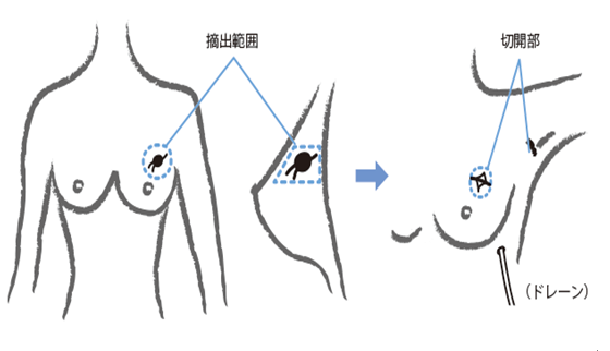 乳腺癌保乳手术