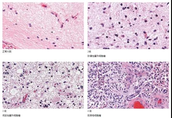 星形细胞瘤分级