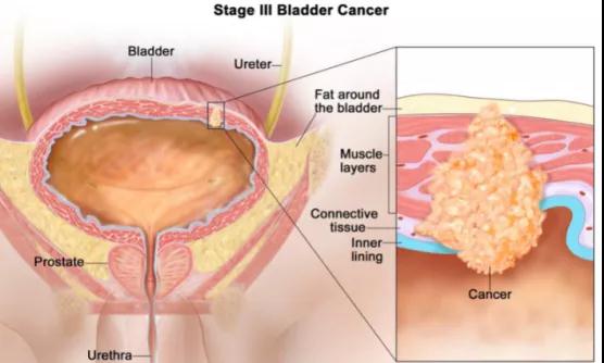 膀胱癌治疗