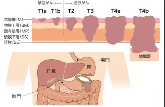 日本治疗胃癌