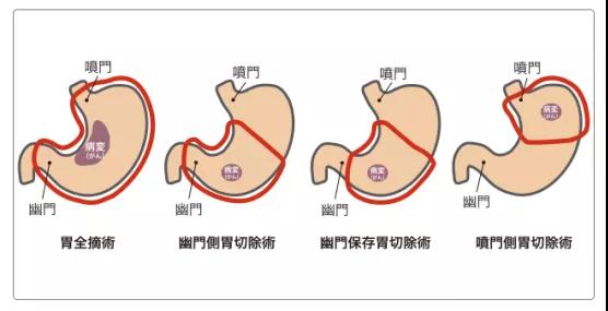 胃癌手术治疗