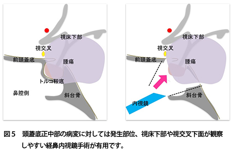 内窥镜颅底手术