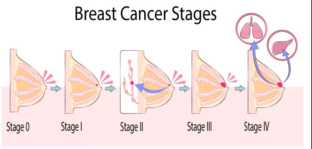 乳腺癌手术治疗