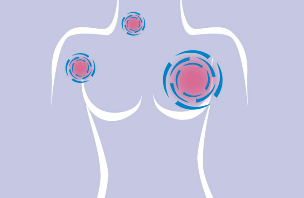 乳腺癌手术化疗