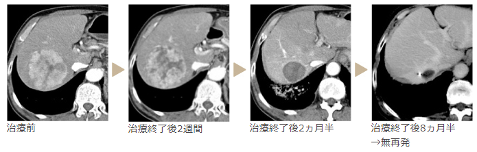 肝癌质子治疗