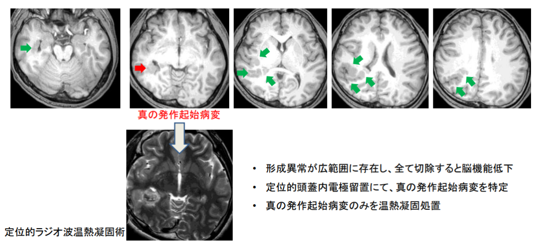 癫痫日本手术治疗