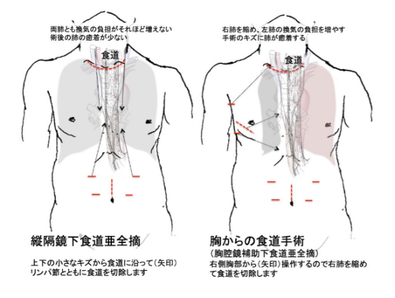 高龄食道癌患者治疗