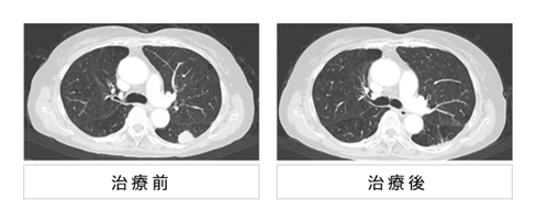 日本质子重离子治疗