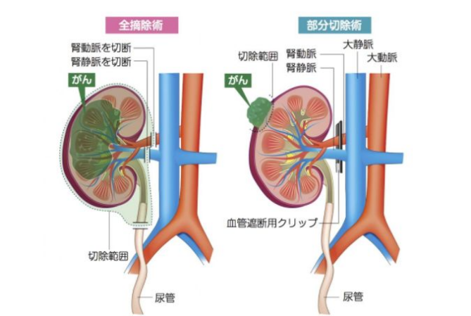 肾癌手术治疗