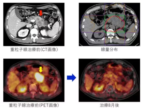 胰腺癌质子治疗