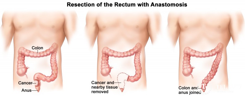 结肠癌直肠癌手术治疗