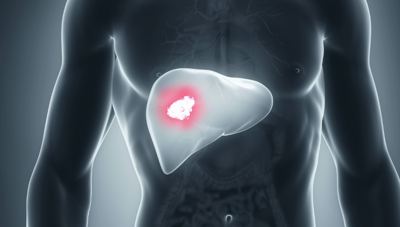 质子治疗肝癌类型，肝癌质子重离子治疗中心