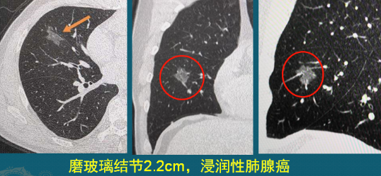 肺磨玻璃结节 肺癌