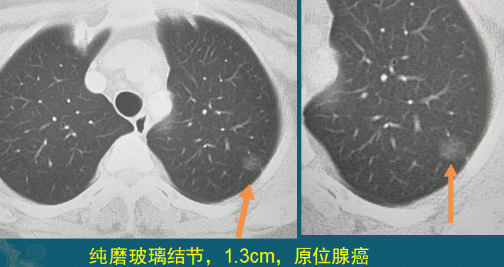 肺磨玻璃结节 肺癌