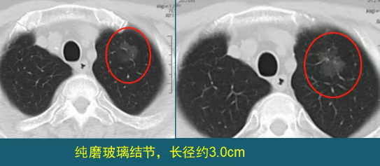 肺磨玻璃结节 肺癌