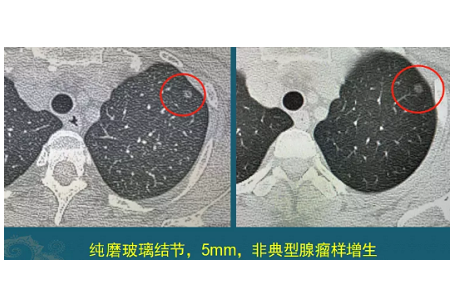 肺磨玻璃结节 肺癌