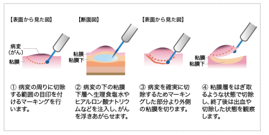 日本食道癌治疗