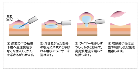 日本食道癌治疗