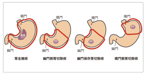 日本胃癌治疗