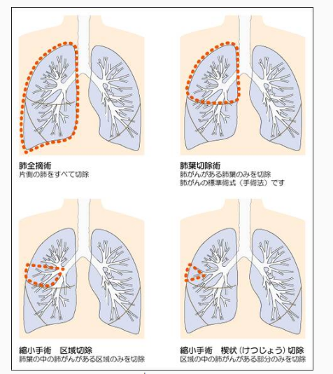 早期肺癌手术方案效果